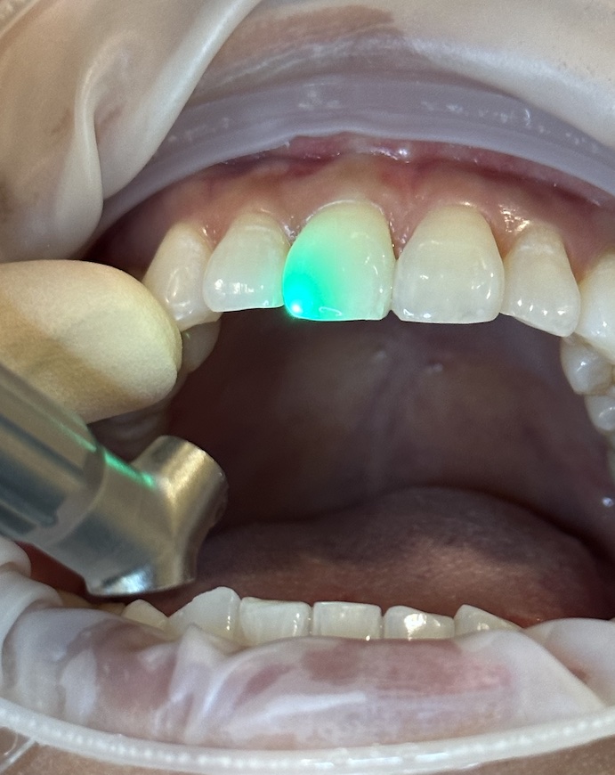 Laser Dentistry